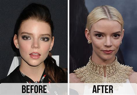 anya taylor-joy surgery|Anya Taylor